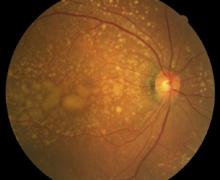 In dry Age-Related Macular Degeneration, yellow spots and patches deposit at the macula