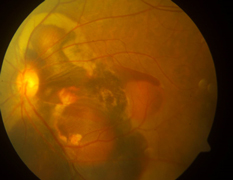 Extensive bleeding at the macula in wet Age-Related Macular Degeneration.