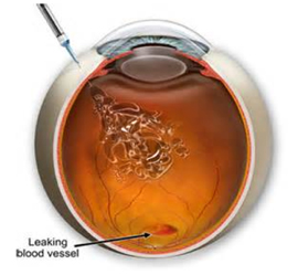 玻璃体腔注药治疗采用极细的针头将药物直接注入眼睛里的玻璃体腔