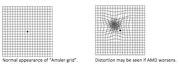 Normal appearance of "Amsler grid" versus Distorted vision of Age-Related Macular Degeneration eyes