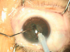 Cataract surgery procedure