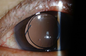 Artificial lens implanted in the eye during cataract surgery to help focus light