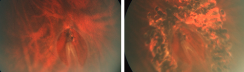 A typical U-tear (horse-shoe tear) in retina tear, and the laser treatment in retina tear for U-tear sealed