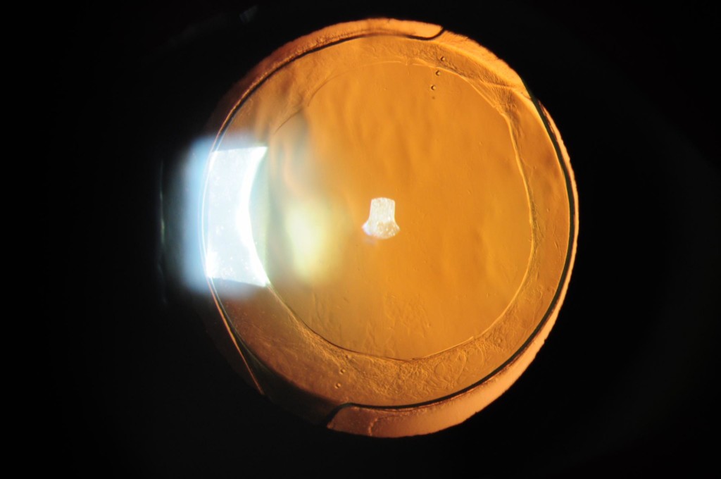 A toric IOL with the three alignment dots on each side of the lens used to reduce pre-existing astigmatism.