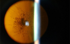 A Posterior Subcapsular Cataract
