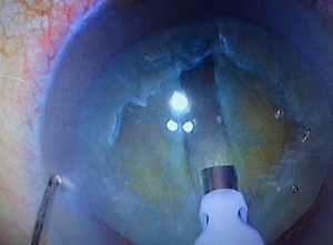 Cataract surgery procedure, Phacoemulsification, use of an ultrasonic device to emulsify and remove the cataract
