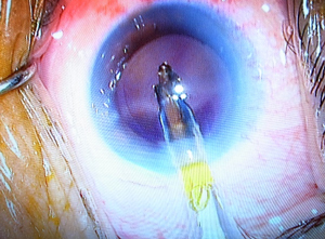 Inserted an intraocular lens implant into the eye to replace the removed cataract
