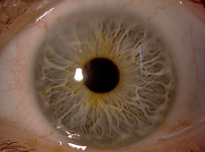 The eye after Cataract surgery
