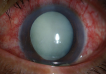 An overly advanced cataract has caused cataract-induced glaucoma.