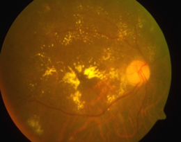 Diabetic Maculopathy Eye is yellowish and has small damaged blood vessels in the retina
