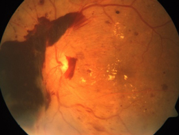 Diabetic Retinopathy, damaged blood vessels in the retina