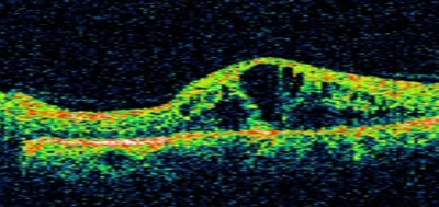 Intravitreal injection therapy is extremely effective for a range of retinal / macular diseases. This pre-treatment scan shows the swelling of the macula (macular edema) due to diabetes.
