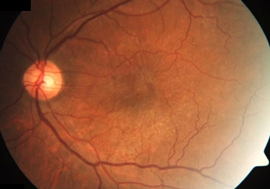 视网膜前膜是生长于中心固视点表面的薄层瘢痕组织