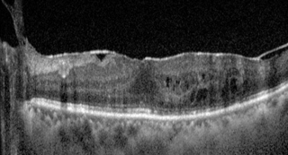 Swelling macula caused by the epiretinal membrane