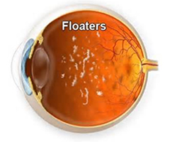 Eye floaters and flashing lights are due to aging changes in the vitreous gel of the eye