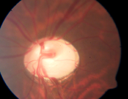 A Glaucoma eye with optic neuritis and nerve around the central vision