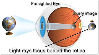 In Hyperopia, farsighted eye, light rays focused behind the retina resulting in blurry images in a short distance