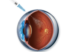Intravitreal Injection Singapore