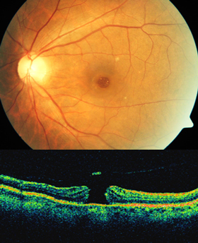 A Macula hole eye scan, and an eye with optic neuritis and nerve around the central fixation point of the eye