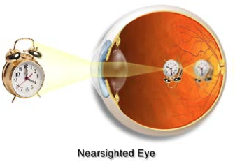 In Myopia, nearsighted eyes, images are formed in front of the macula, resulting in blurred vision