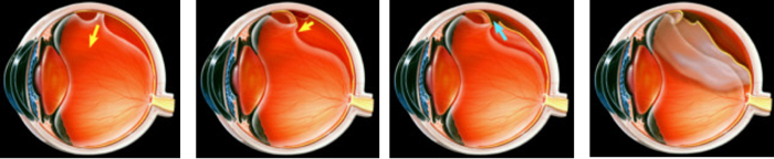 Retinal detachment happens when the degenerating gel in the middle of the eyeball shrinks and pulls on the retina