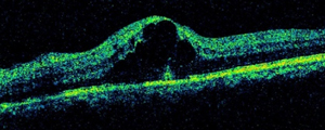 视网膜静脉阻塞引起的严重黄斑水肿的眼部扫描