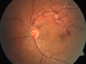 A branch retinal vein occlusion (BRVO) is due to blockage of one of 4 large retinal veins, each supplying a quarter of the retina.