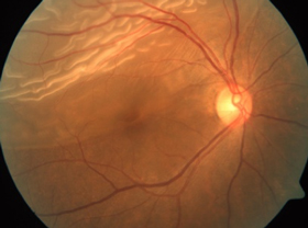 视网膜劈裂是因视网膜变薄，然后更容易出现裂孔在玻璃体凝胶退变