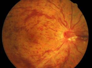 A central retinal vein occlusion (CRVO) is due to blockage of the main vein supplying the entire retina. In general, a CRVO is more serious than a BRVO.