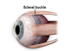 Scleral Buckle Singapore