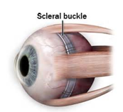 In scleral buckle surgery, a silicone band or sponge is stitched to the external wall of the eye to repair a retinal detachment