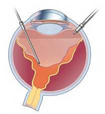 玻璃体切除术是一款在巩膜上做一个非常微小的切口，让微手术器械得以进入眼内进行玻璃体的切割及清除