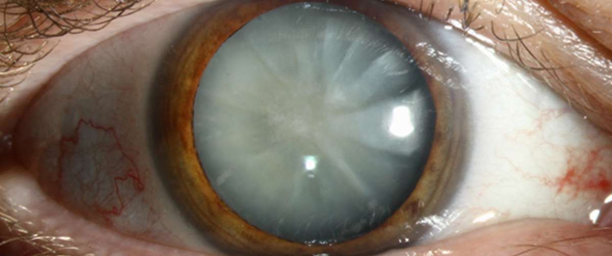cataract - edited